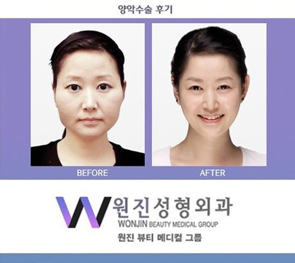 Chùm ảnh: Gương mặt hoàn hảo sau phẫu thuật thẩm mỹ của các cô gái xứ Kim Chi 4