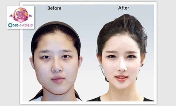 Chùm ảnh: Gương mặt hoàn hảo sau phẫu thuật thẩm mỹ của các cô gái xứ Kim Chi 5