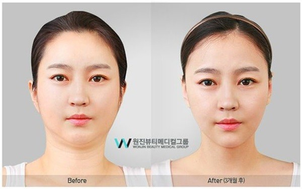 Chùm ảnh: Gương mặt hoàn hảo sau phẫu thuật thẩm mỹ của các cô gái xứ Kim Chi 9
