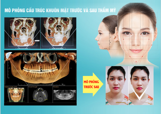 Phẫu thuật Gọt mặt V-line 3D Hàn Quốc 22