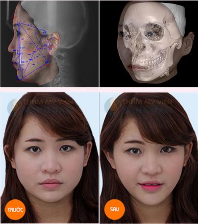 Phẫu thuật Gọt mặt V-line 3D Hàn Quốc 23