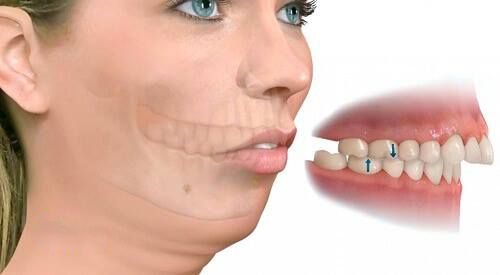 Bị hô nên niềng răng hay tiến hành phẫu thuật?1