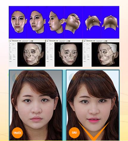 Đài truyền hình Hà Nội giới thiệu công nghệ thẩm mỹ khuôn mặt V-line 3D 123