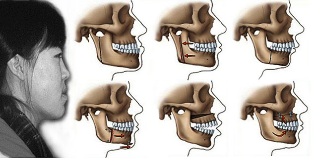 Mô hình chỉnh hàm hô móm để có được hàm răng đẹp