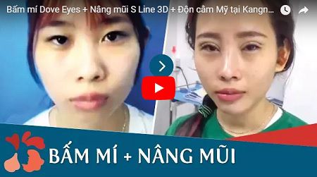 Cận cảnh kết quả phẫu thuật Bấm mí Dove Eyes - Nâng mũi S Line 3D - Độn cằm Mỹ tại Kangnam