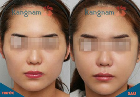 (Các hình ảnh trên là từ các khách hàng trước đây của Kangnam, hiệu quả đối với các trường hợp cụ thể khác có thể khác nhau)