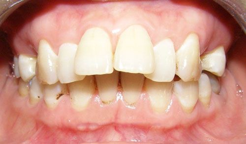 Hình ảnh răng hô hàm trên