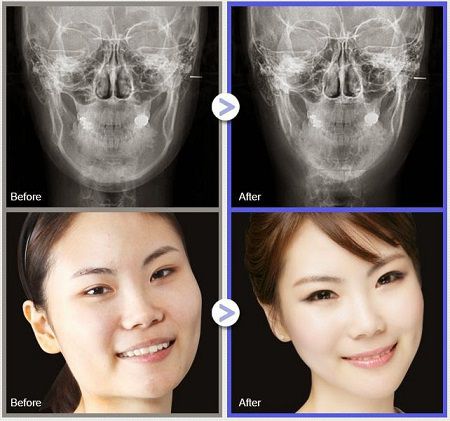 Phương pháp gọt mặt V-line 3D mang đến bạn khuôn mặt đẹp không góc chết