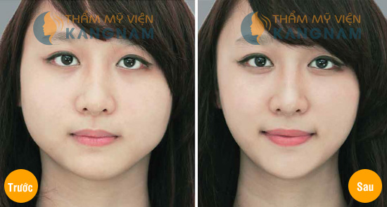 Thẩm mỹ khuôn mặt V-line 3D: Mặt đẹp như ý sau 4 tuần 1
